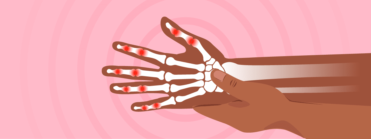 Picture of a hand with the hand bones (skeleton) shown inside, pain points marked at the joints in the fingers. These are inflammation points representing arthritis (osteoarthritis).
